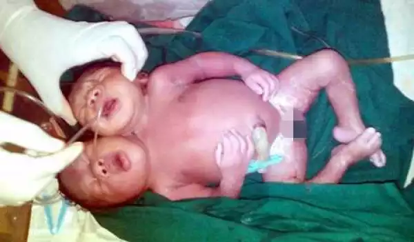 Doctors and Nurses in Shock as Baby with Two Heads is Delivered in Lagos Hospital (Photo)